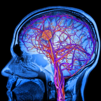 Benefits of Exercise for Alzheimer's Disease